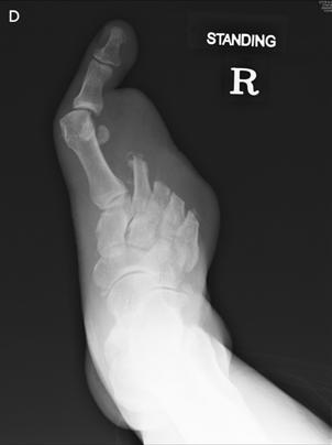 (C, D) The picture and the radiograph show the foot after lateral 4 ray