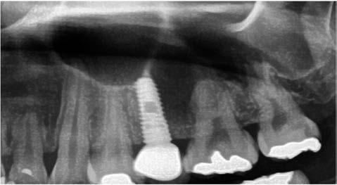 Kim D, et al: Immediately placed implant without primary stability: case