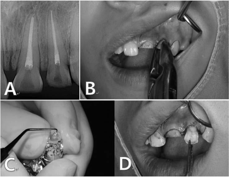 Jung KH, et al: Intra-alveolar transplantation for crown-root fractured anterior maxillary tooth 23 증례보고 상기환자는 15세여자환자로운동중넘어져서본원에내원하였다. 초진시구외부위의외상은없었고, #21, 22 치아의치수가노출된치관파절을보였다.