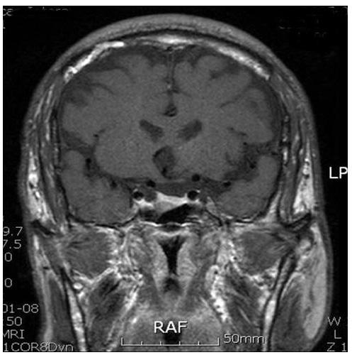 - 박건우외 9인 : 말단비대증환자에서병발한조기위암 1예 - Fig. 2. Sella MRI. Coronal image demonstrates 13 9 mm sized well defined low signal intensity mass in the right side of pituitary gland. Fig. 3.
