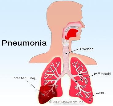 S. Pneumoniae (Pneumococcus) Pneumococcal pneumonia The most cause of community-acquired pneumonia > 75% of pneumonia in the pre-antibiotic era 5-15% of