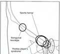 strains ( mc) Osteitis pubis Sports hernia Groin disruption Avulsion fractures Nerve compression Iliopsoas bursitis