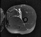 진단 2) Groin Disruption 서혜부단열 : MRI intermuscular or intramuscular hematoma 잦은결장,