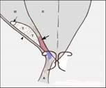 서혜부단열 Conjoint tendon : a fusion of the tendons of int. obl. & trans. Abd.