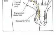 abdominal pain +/- Adductor pain Tearing of abdominal muscle attachment to pelvis Tearing of conjoined tendon Adductor microtearing