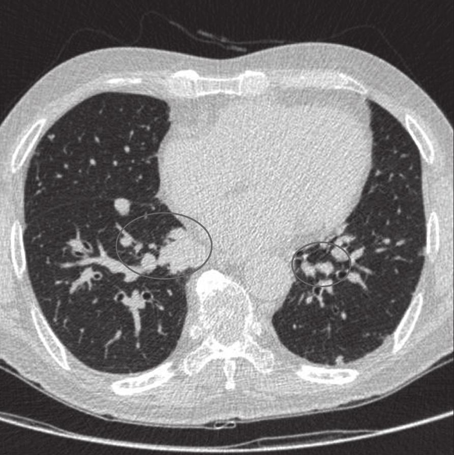 배뇨장애에대한증상완화를위하여경요도전립선절제술 (transurethral prostatectomy) 을받았으며, 당시지속적인혈압의상승이관찰되어고혈압으로진단받고 amlodipine 을 1일 10 mg 복용하기시작하였다. 수술후합병증없이경과관찰중 4주전부터좌하지의근력저하가심해짐을호소하였다.