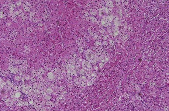 Hematoxylin and eosin 염색에서호산성세포질을가진치밀세포와세포질내에지방방울이풍부한투명세포가관찰되었다 (Fig. 5). 고찰부신종양은대개편측으로발생하나 15% 정도에서양측성으로발생하는것으로알려져있으며, 전이성암종, 갈색세포종, 림프종과관련이있다 [9].