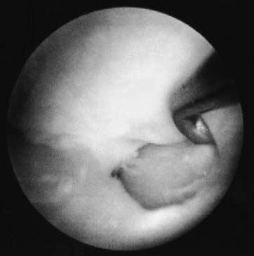 52 박민종 김청 Ulnar Head Radius A B H C Fig. 1. A: Arthroscopic view from the 3-4 radiocarpal portal showing a type I-A C tear.