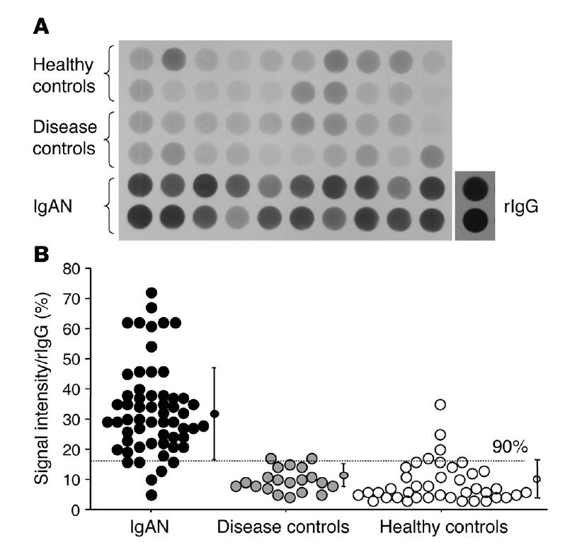 - Chun Gyoo Ihm. IgA nephropathy over 40 years - 으로생각된다. 일찍이 oral tolerance failure에의해 IgA 대신에지속적인 IgG와 IgM의증가가초래되고그로인한효과적인보체활성화로인해사구체신염이일어난다는주장도거론되어왔다 25).