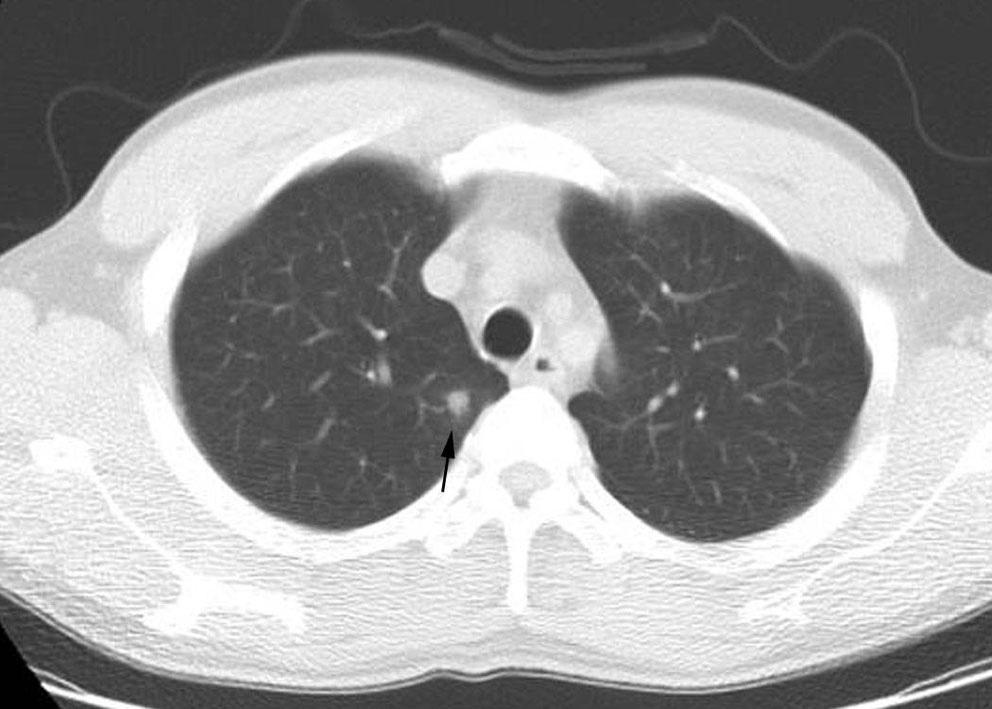 A B Fig. 1. A 43-year-old man with simple pulmonary eosinophilia.
