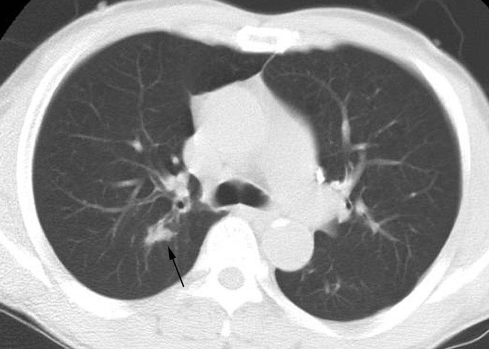 Low-dose CT shows about a 16mm sized irregular nodule (arrow) in the right upper lobe.
