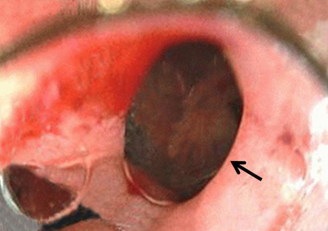 Figure 1. Endoscopic finding of type I duodenal perforation.