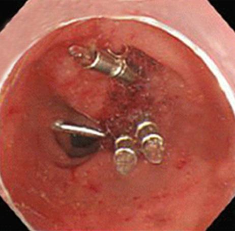 (B) Endoscopic clip closure is performed. Figure 2. Abdominal CT finding of type perforation.
