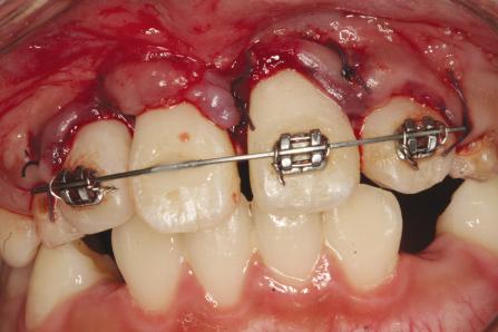 대한소아치과학회지 39(2) 2012 Fig. 12. Repositioned tooth was splinted and endodontic treatment was performed. Fig. 13. After 30 months. 자를이용하여조심스럽게상악우측중절치를발치하였다. 치아를수여부에위치하고봉합한후기존의고정식장치의강선을이용하여고정을시행하였다 (Fig.
