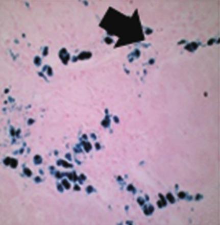 viverrini infection and associated hepatobiliary disease is associated with iron loaded M2-like macrophages in hamsters.