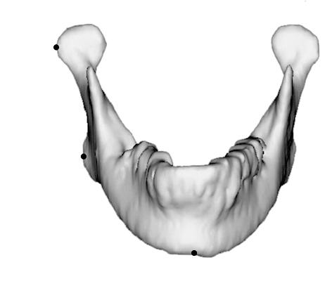 2 계측항목의설정및계측안면비대칭시좌우차이를보일수있는하악골계측항목으로 ramus length, mandibular body length, condylar neck length, frontal ramal inclination, lateral ramal inclination