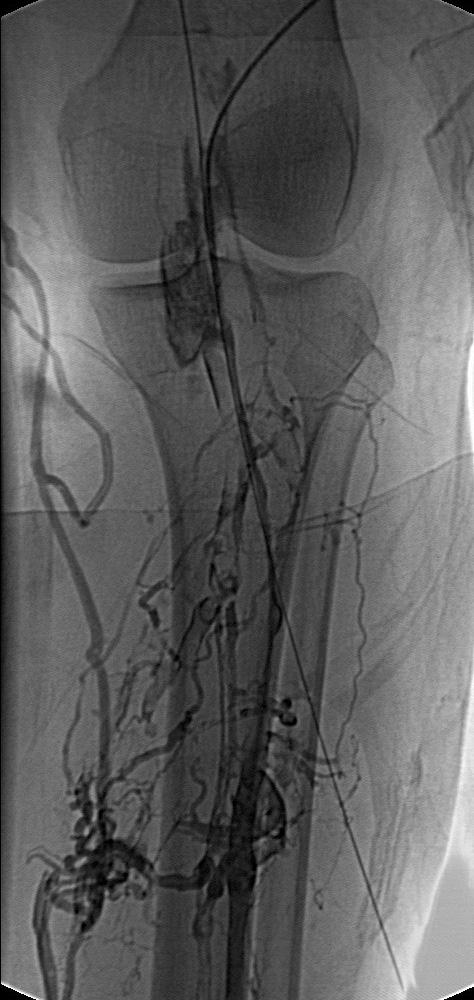 A B C Fig. 1. Deep vein thrombosis of left lower extremity in 48-years-old female.