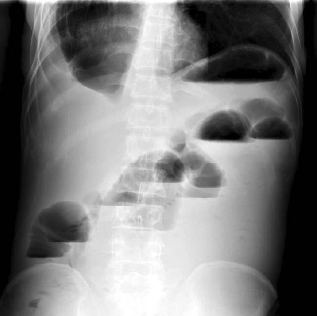 Computed tomography scan of the abdomen shows invagination of ileum to ileum with multiple fluid-filled and dilated loops of the small bowel.