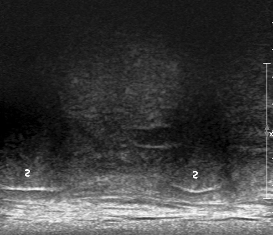 95 Ultrasound-Guided Intervention in Thoracic Spine 잡고고정하기에는크기가작은선형이편하고늑막을관찰하며 미세하게바늘의이동을보는데유리하다고생각하여선형탐촉 자를선호하고있다.