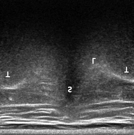 97 Ultrasound-Guided Intervention in Thoracic Spine 이는비교적흐릿한고에코성선을관찰할수있는데이는폐를싸고있는벽측늑막 (parietal pleura) 이보이는것이다.