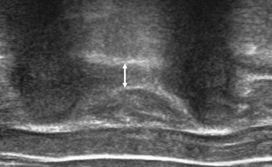 99 Ultrasound-Guided Intervention in Thoracic Spine 는중요한장점을갖고있으므로안전하게시술할수있는방법 LL C TR SC RL 이된다. 또한이시술은다른부위척추에서는기대할수없는효과를보인다.