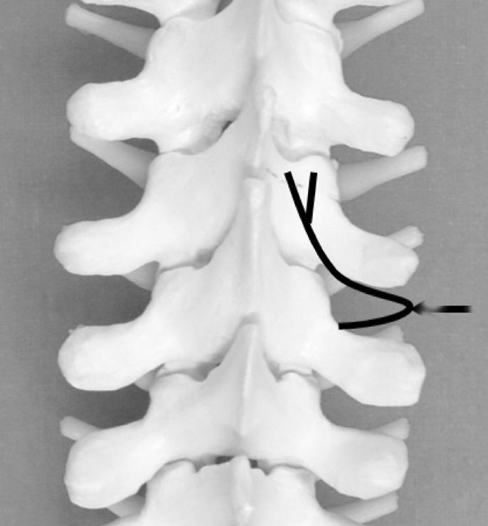 () t mid-thoracic levels (T5-T8), the medial branch does not contact with bone and is suspended in the intertransverse space (arrow).