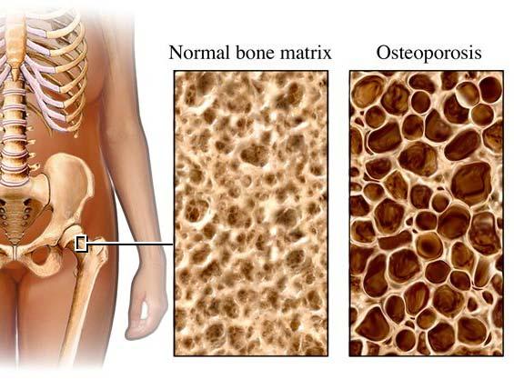2 노화로인한신체구조의변화 골다공증 (Osteoporosis) 골밀도감소 노화로인한신체구조의변화 신장감소 자세변화 15 cm lost between 40 & 70 yrs old 척추후만증 (Dorsal Kyphosis) 3 2