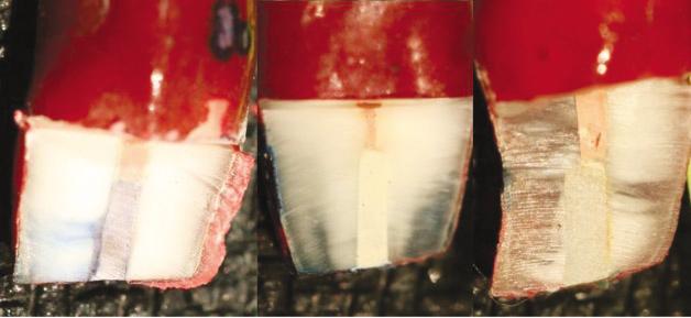 Figure 2. Representative samples from each group with dye leakage score. MTA specimen shows leakage with score 2 and AMTA and EPPC specimens show no leakage.