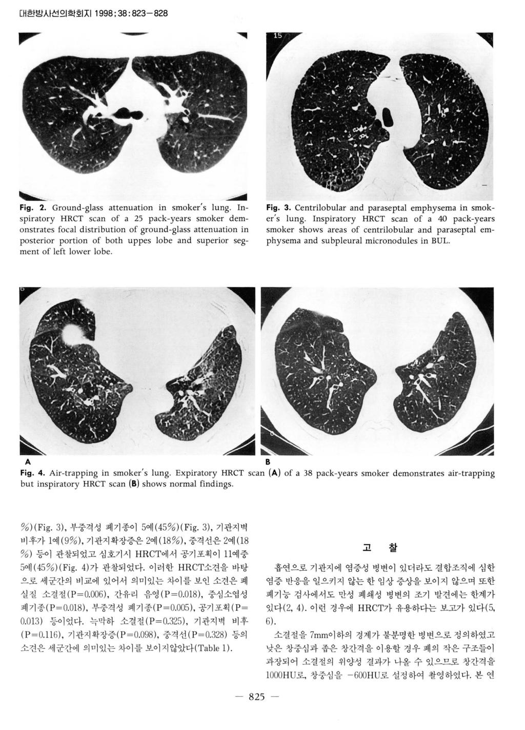 1000HU 로, 창중심을 -6 00HU 로설정하여촬영하였다. 본연경 대한망시선의학회지 1998; 38: 823-828,...- - -... 1 ~... Fig. 2. Ground-glass attenuation in smoker s lung.