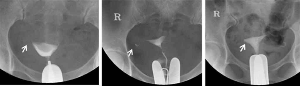 제 37 권제 4 호, 2010 박찬우 차선화 양광문 한애라 유지희외 5 인 A B C Figure 1. Classification of tubal blockage by their blockage type. (A) Smooth type, Smooth tapered obstruction is seen on Rt. proximal tube (arrow).