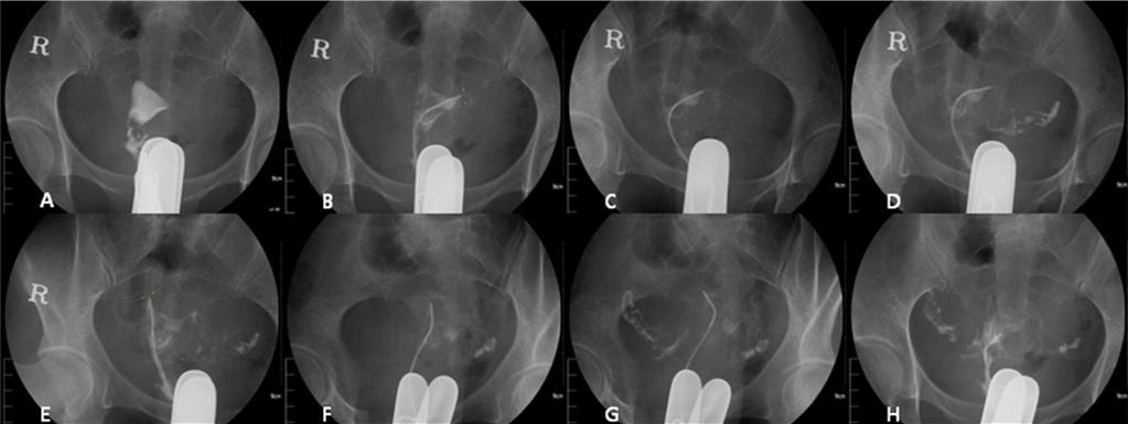 Efficacy of Transcervical Fallopian Tube Catheterization in Infertility Patients with Fallopian Tube Occlusion. Korean J Reprod Med 2010. Figure 2.