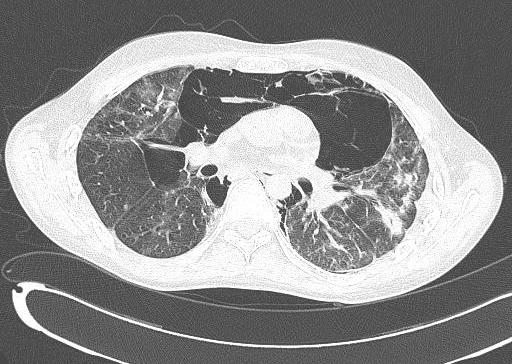 lung attenuation and bronchial dilatation in both lower lungs, pneumomediastinum, and pneumothorax are similar to the previous scan.