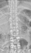 진단적검사 Plain radiographs (X-ray) 1) 척추의정렬및구조