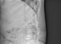 진단적검사 Plain radiographs (X-ray) 1) 척추의정렬및구조 (Alignment and anatomy) 2)
