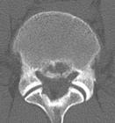 골단환골절 LARF : Lumbar Apophyseal Ring Fracture