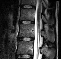 시견열골절avulsion fracture에의해발생역도등반복적굴곡운동을하는경우호발