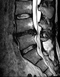 kyphosis( 등굽음 ) 후만은등을펴도교정되지않음 골격성숙 skeletal