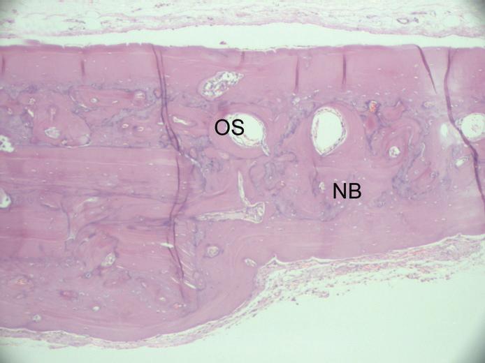The collagen matrix biomaterial appears completely absorbed ( =defect margin; NB=new bone; OS=osteon; H&E stain; original magnification: A 16, B 100).