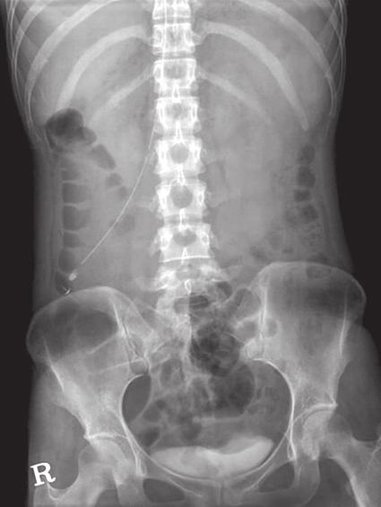 Seung-Beom Lee, et al: A Case Report of Superior Mesenteric Artery Syndrome after Acute Gastroenteritis 압박된소견을보였다. 상장간막동맥과복부대동맥사이의거리는 4 mm로좁아져있었다 (Figure 2).