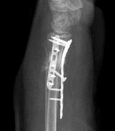 Anteroposterior and lateral radiographs of the left wrist.