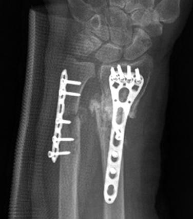(B) Anteroposterior and lateral radiograph showing reduction and stabilization with variable-angle locking compression plate for