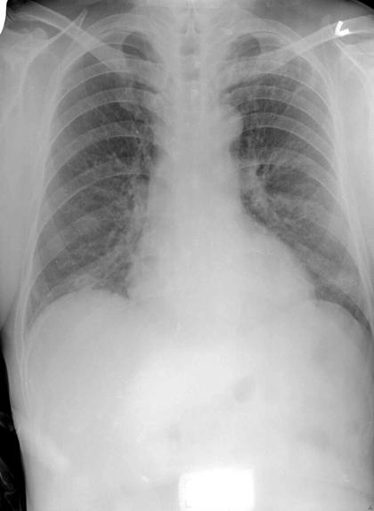 - 박철연 권정석 정진욱 이충기 현대성 최정윤 - Fig. 3. Chest PA shows pulmonary tuberculosis in both upper lobes, undetermined activity.