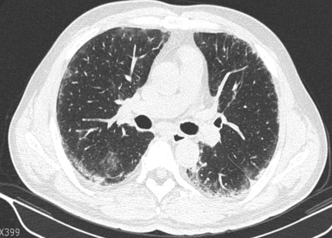 Chest radiological findings showed bilateral interstitial pulmonary fibrosis. 같이사용하였다. 하지만치료 1주일후에빈혈을동반하지않은백혈구감소증 (2,980/mm 3 ) 과혈소판감소 (37,000/mm 3 ) 소견을보였다.