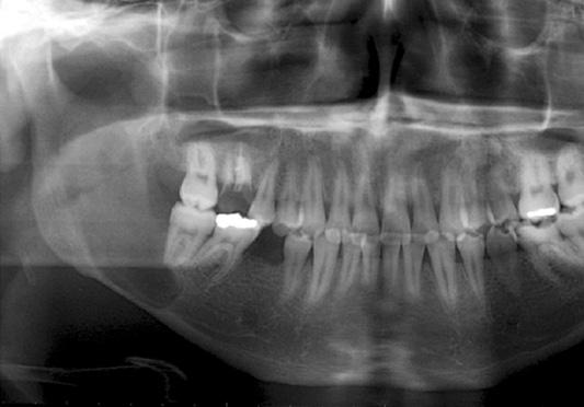 The correlation between cystic tumor/cyst and size of lesion (5 years: 98-005) Number Large Small Ratio a: keratocystic odonotogenic tumor b: odontogenic orthokeratocyst c: primordial cyst d: