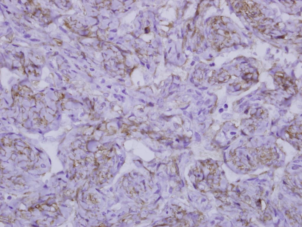 () The left tumor of case 1 consists of fibrotic stroma and occasional calcification (upper) alternating with the cellular area (H&E stain, 100).