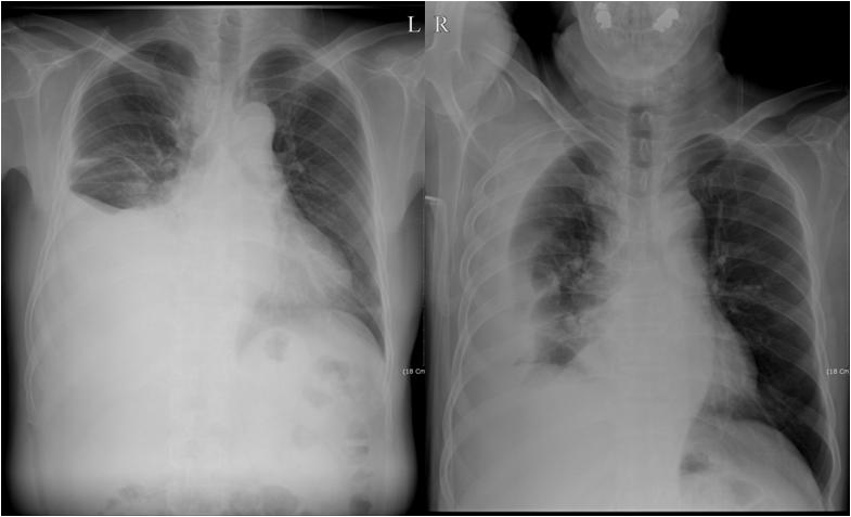 - Myung Ho Jeong, et al. pancreaticopleural fistula cured with endoscopic pancreatic duct drainage - Figure 1. The chest X-ray shows large pleural effusion in the right hemithorax ().