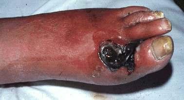 Wagner ulcer classification* Grade Description 0 No ulcer, but high