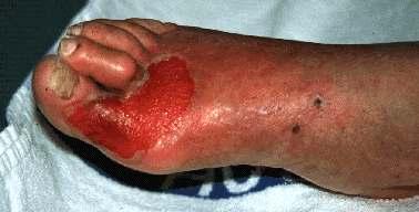 full thickness ulcer 2 Deep ulcer, may involve tendons.