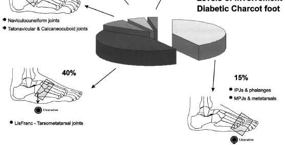 Charcot foot (Diabetic Neuroarthropathy) Adapted from Sanders