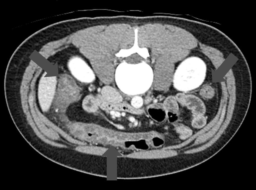 Oseltamivir Induced Hemorrhagic Colitis 소판 156,000/mm3였으며 백혈구 감별 계산에서 호중구 80.6%, 림프구 14.5%, 호산구 0.7% 소견을 보였다. 일반 화학검사에 서 혈액요소질소 10.7 mg/dl, 크레아티닌 0.8 mg/dl, 총단백 질 6.7 g/dl, 알부민 4.2 g/dl, 총빌리루빈 0.